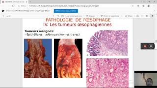 pathologie du tube digestif Pr MEDJAMIA [upl. by Paine]