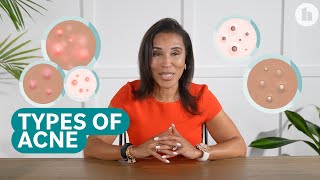 The Different Types of Acne and How to Treat Them [upl. by Yrocal]