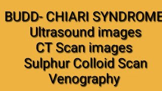 BuddChiari Syndrome on Radiology [upl. by Meekyh53]