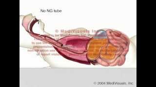 NG Tube vs Aspiration  Fluid Regurgitation [upl. by Tallula]