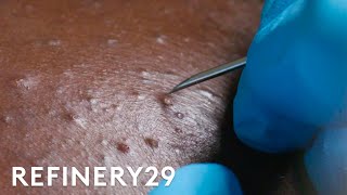 I Got Professional Blackhead Extractions  Macro Beauty  Refinery29 [upl. by Trenton]