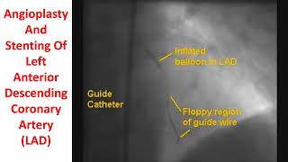 Angioplasty And Stenting Of Left Anterior Descending Coronary Artery [upl. by Ciredor]