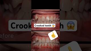 Crooked teeth braces short braces orthodontist dentalbraces [upl. by Seldan442]