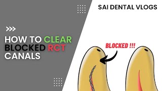 HOW TO CLEAR BLOCKED RCT CANALS  FILE NOT REACHING APEX [upl. by Esli]