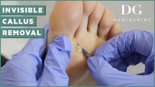 Callus removal from feet a young yoga instructor  The Foot Scraper DG Podiatrist [upl. by Stovall]