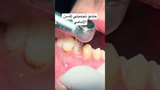 حشو تجميلي للسن الأمامي composite restoration of anterior teeth [upl. by Eiluj]