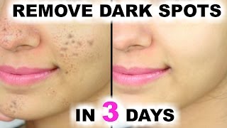 In 3 DAYS  Remove DARK SPOTS BLACK SPOTS amp ACNE SCARS  Anaysa [upl. by Monro]