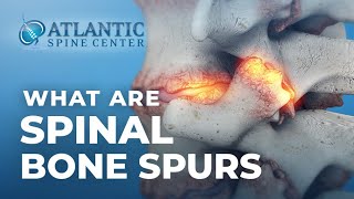 What Are Spinal Bone Spurs  Spinal Osteophytes [upl. by Anastase831]