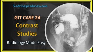 FRCR Radiology  A 58 yrs old patient presented with constipation  GIT Contrast Case 24 [upl. by Sig2]