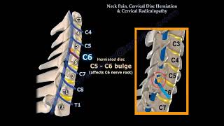 quotNeck Pain Cervical Disc Herniation and Radiculopathy Causes Symptoms and Treatmentquot [upl. by Erelia]