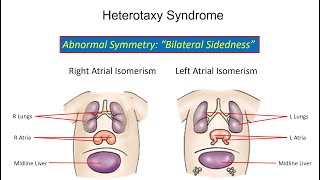 Fetal Echo Understanding Cardiovascular Abnormalities in Heterotaxy Syndrome [upl. by Ahsiak]