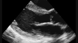 Colour Doppler Echocardiogram In Anterior Wall Myocardial Infarction AWMI [upl. by Ellahcim]