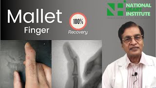 Mallet Finger Treatment In Hindi Dr Karoon Agrawal [upl. by Ambrosio]