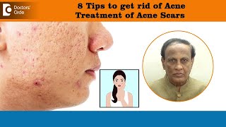 8 Tips to get rid of ACNE SCARS  Best Treatment for Deep Acne Pits  DrD A Satish Doctors Circle [upl. by Aeli]