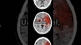 SturgeWeber Syndrome Mnemonic medicalstudent medicaleducation usmlepreparation DiagnosticLens [upl. by Sirred]