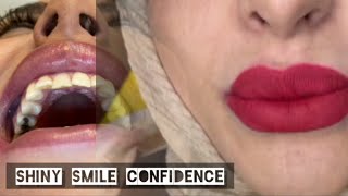 Shiny Smile Veneers Confidence [upl. by Naujad389]