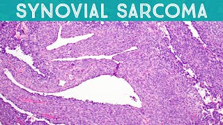 Synovial Sarcoma explained in 5 minutes Soft Tissue Pathology Basics [upl. by Nylecaj]