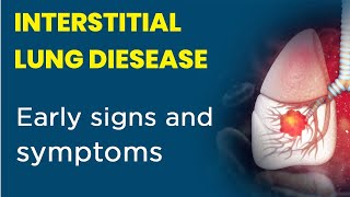 INTERSTITIAL LUNG DISEASE Hindi  TYPES OF ILD AND ITS SYMPTOMS  CURE91 [upl. by Ylla]