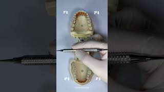 SEXTANTES NA PERIODONTIA  ODONTO UFRGS [upl. by Clevey]