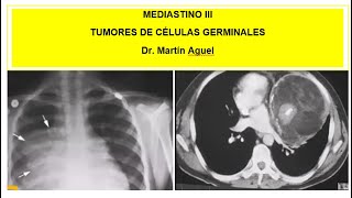 TUMORES GERMINALES MEDIASTINALES [upl. by Anod695]