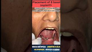 Now fixing new teeth is possible in just 7 days with basal implants basalimplants [upl. by Udenihc536]