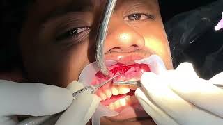 Maxillary tooth apicectomy  curettage and retrograde obturation [upl. by Leinad]