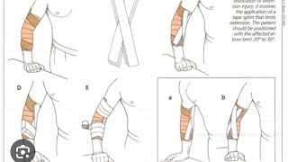 Elbow tape collateral ligaments [upl. by Imuyam865]