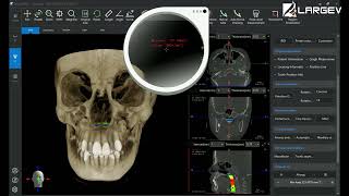 Software de análisis dental LargeV AI realiza automáticamente análisis de las vías aérea [upl. by Durarte]