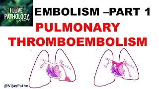 EMBOLISM Part 1 Pulmonary amp Systemic thromboembolism [upl. by Rox]