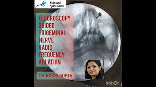 Fluoroscopy guided trigeminal nerve radiofrequency ablation for trigeminal neuralgia Dr Rakhi Gupta [upl. by Valer]