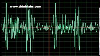 Atrial Septal Defect slow [upl. by Pantheas]