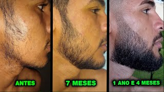 1 ANO E 4 MESES USANDO MINOXIDIL Pant Kirkland e Dom Pelo [upl. by Kotz]