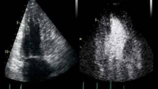 CONTRAST ECHO CARDIOMYOPATHIE TRABECULATION OU NON [upl. by Margarette]