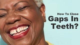 Top 3 ways to close gaps in teeth Braces Composite Fillings Veneers What to choose Pros amp Cons [upl. by Glanville]