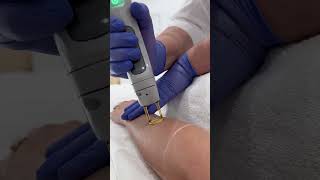 Candela  Laser Hair Removal with Candela GentleMax Pro at Ivory Aesthetics Dubai [upl. by Opal]