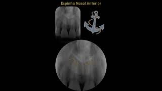 Anatomia radiográfica intrabucal  Região de incisivos centrais superiores  Parte 1 [upl. by Catharine]