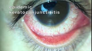 EKC epidemic keratoconjunctivitis [upl. by Adlitam]