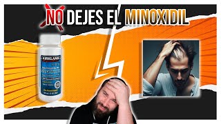 ESTO es lo que PASA si DEJAS MINOXIDIL [upl. by Ojaras334]