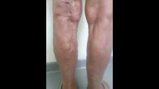 Varicose Veins [upl. by Howey]