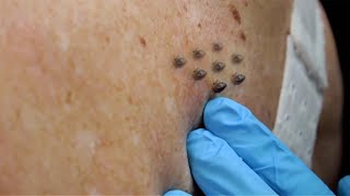 Extreme Blackhead Removal by Hand 2024 [upl. by Allevon165]