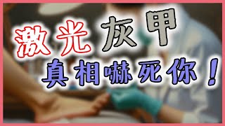 【灰甲成效】激光灰甲有無用  成效極低  點解  真相公開｜美容操作教學 [upl. by Damita]