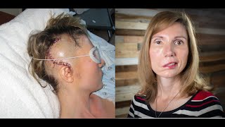 Brain Tumor Journey 2 From dizzy spells headaches vertigo to diagnosis Jodi Orgill Brown [upl. by Enialed]