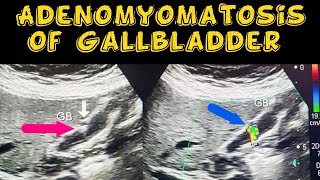 Adenomyomatosis of Gallbladder [upl. by Anotal319]