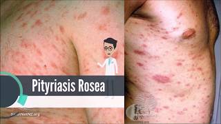 What is Pityriasis Rosea [upl. by Eisned536]