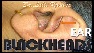 EAR COMEDONES by DrLalit Kasana [upl. by Haldane]