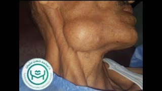 excision of a submandibular salivary gland carcinoma by dr Mohammed Hasan osman [upl. by Wolliw496]