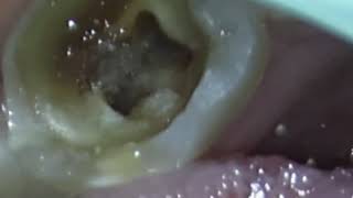 Pulp Stone Removal from Distal Canal in Mandibular First Molar [upl. by Freed]