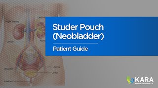 Studer Pouch Neobladder Patient Guide [upl. by Feil]