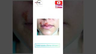 Ever seen these Blisters on someones face Find out what they are herpes dental face [upl. by Nossila594]