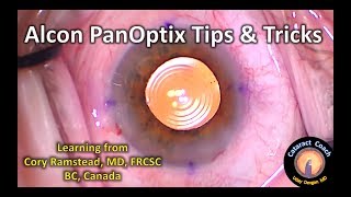 Alcon PanOptix Trifocal IOL Tips amp Tricks for Cataract Surgery [upl. by Lael]